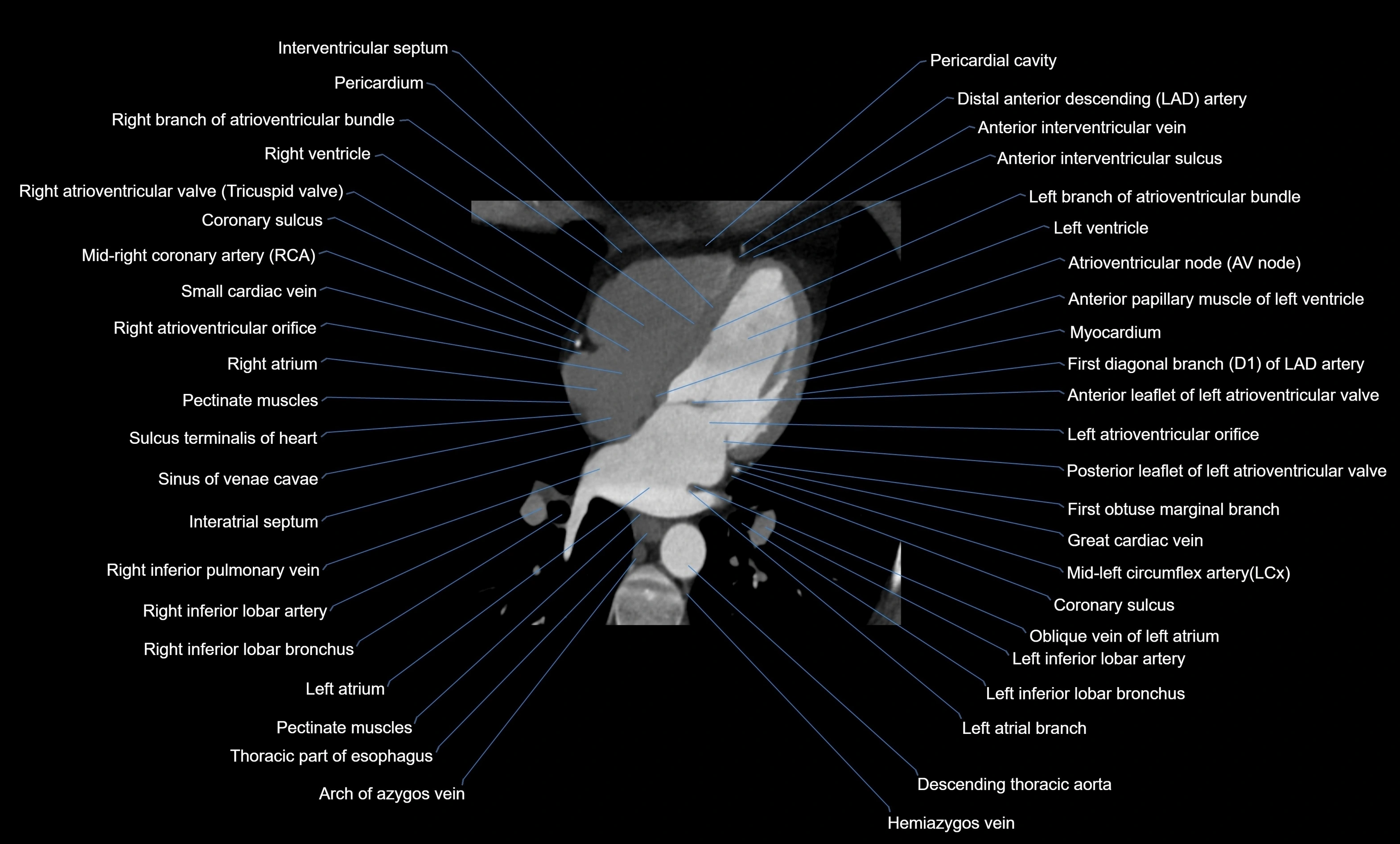 CT heart (coronary angiogram) four chamber view  cross sectional anatomy labelled radiology image -00031.webp